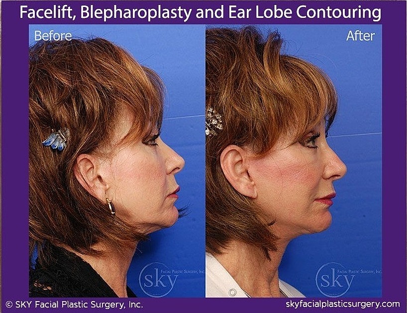 Facelift Before & After