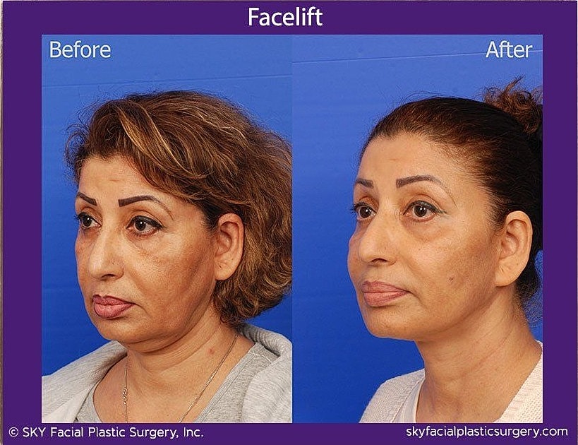 Facelift Before & After
