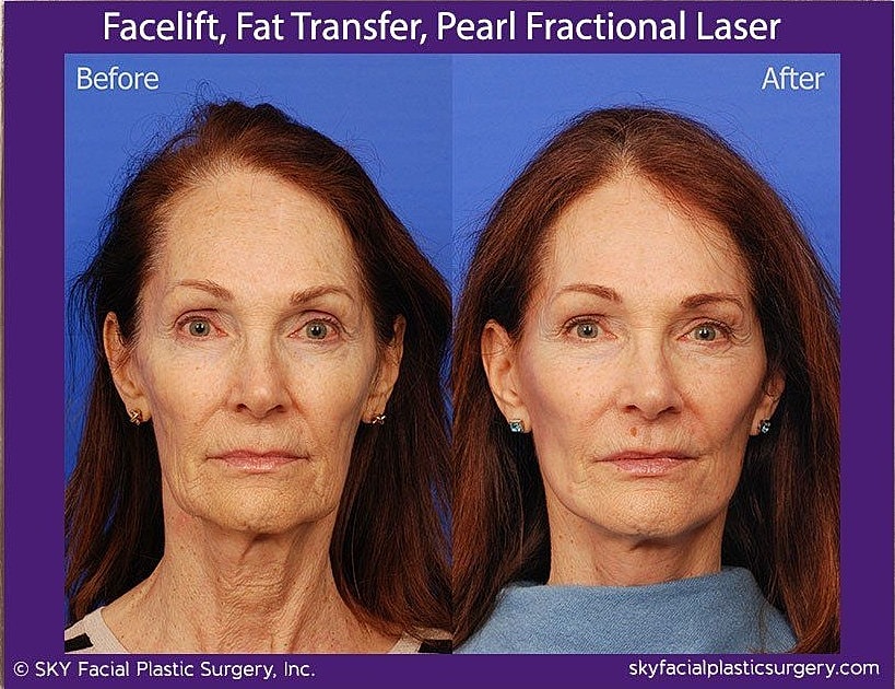 Facelift Before & After