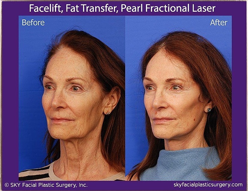 Facelift Before & After