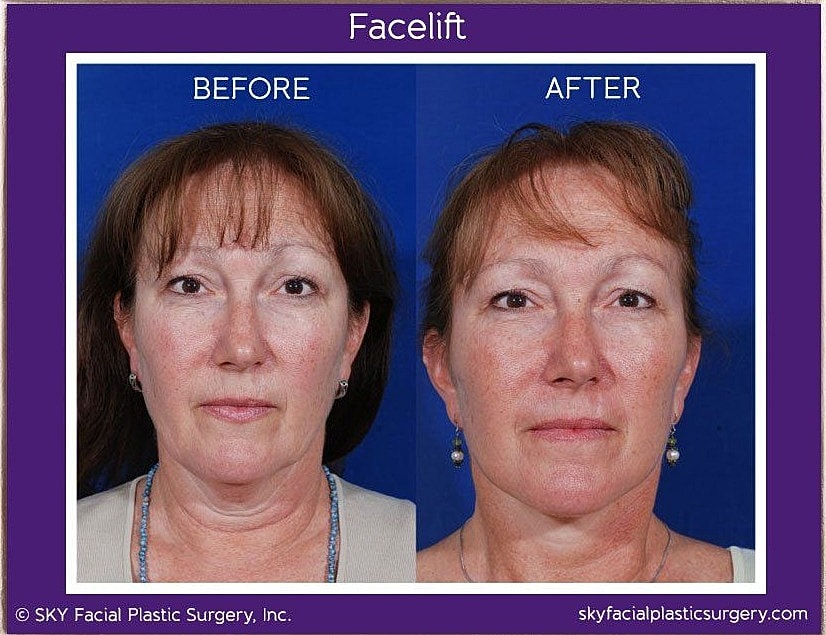 Facelift Before & After