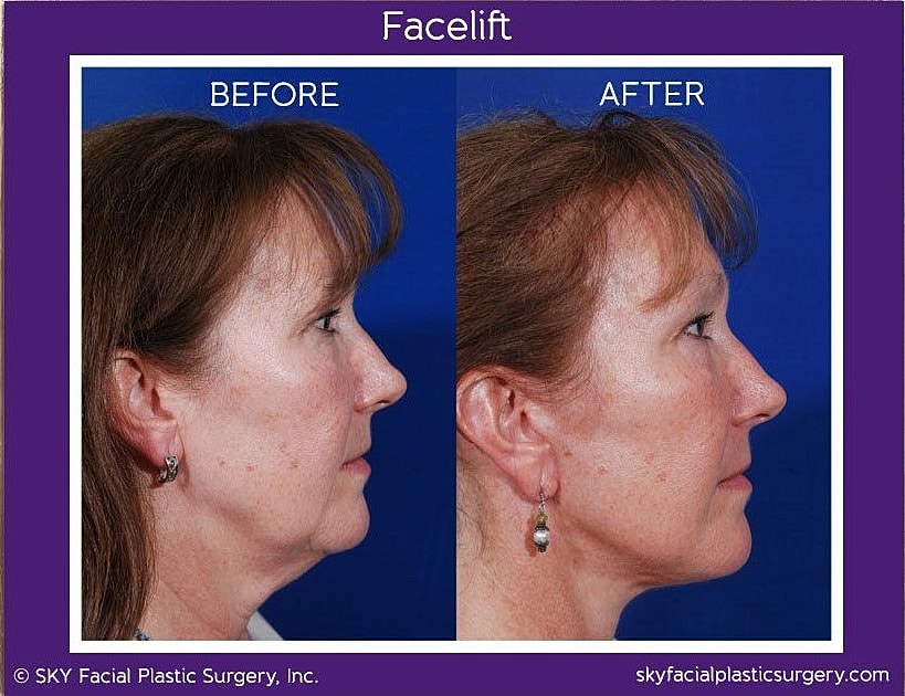 Facelift Before & After