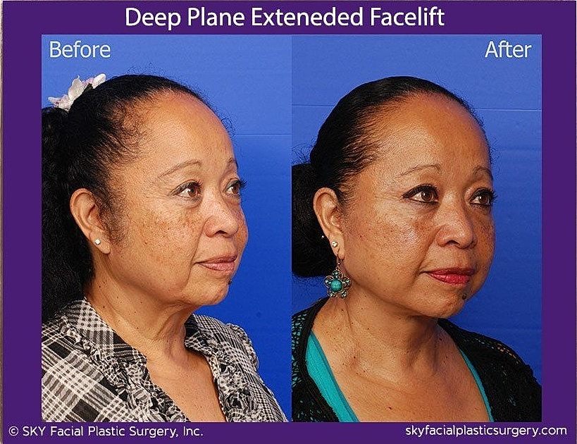 Facelift Before & After
