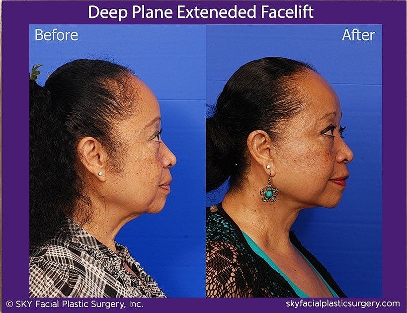 Facelift Before & After