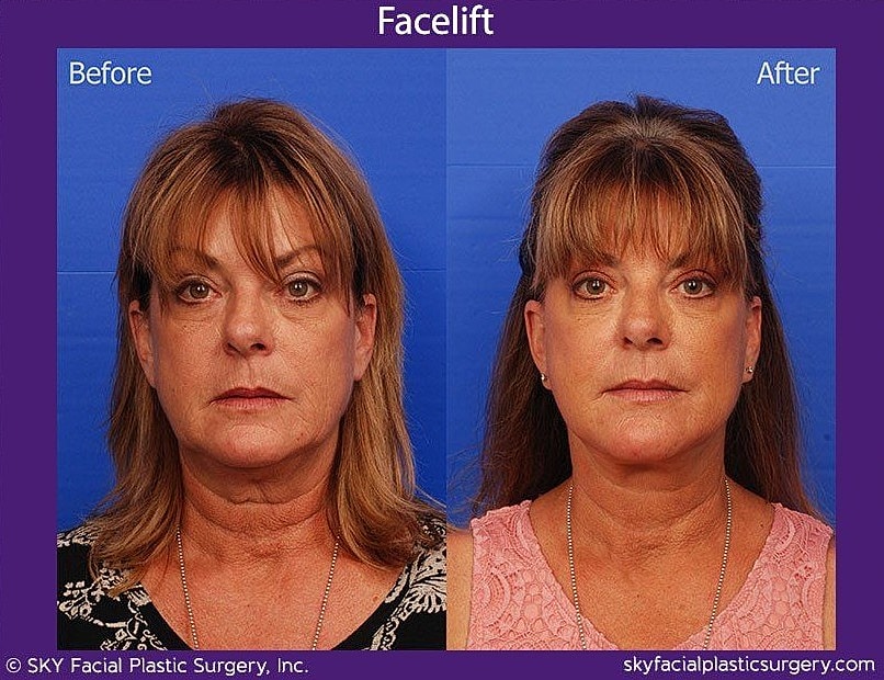 Facelift Before & After
