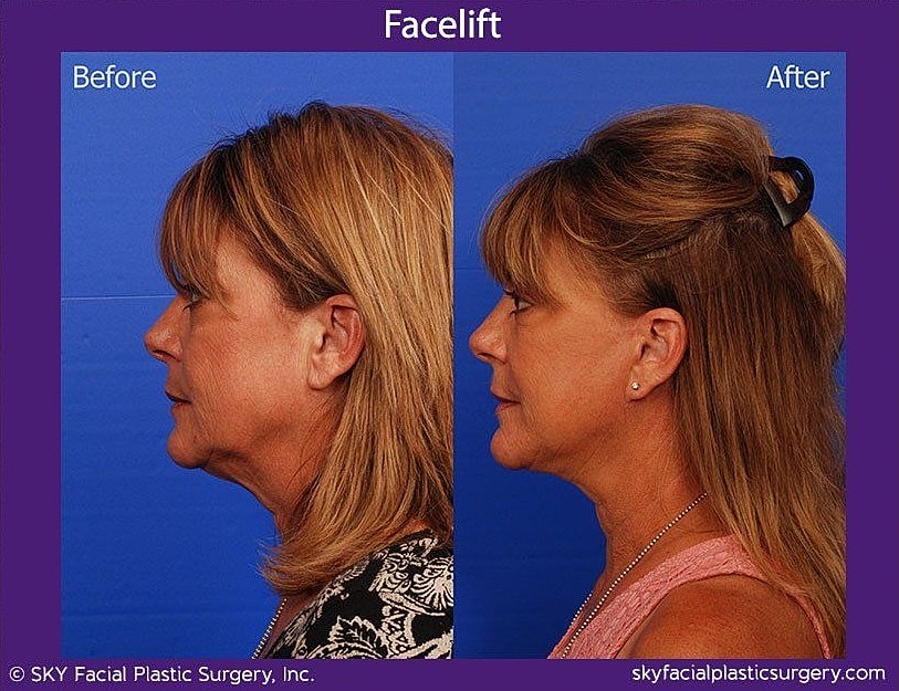 Facelift Before & After
