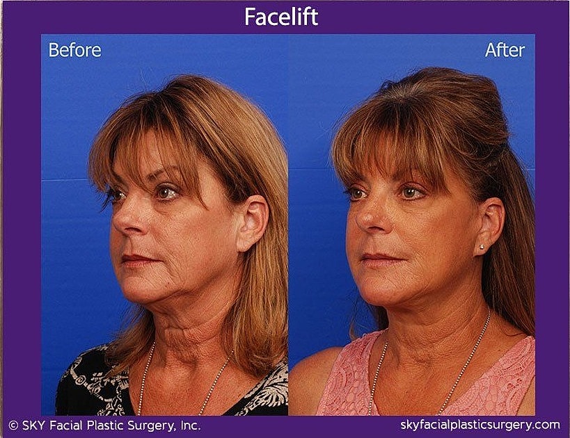 Facelift Before & After
