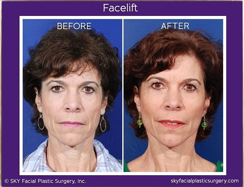 Facelift Before & After