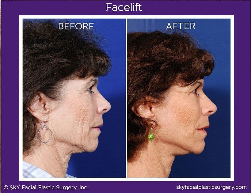 Facelift Before & After