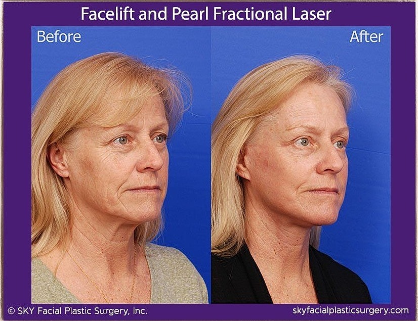 Facelift Before & After