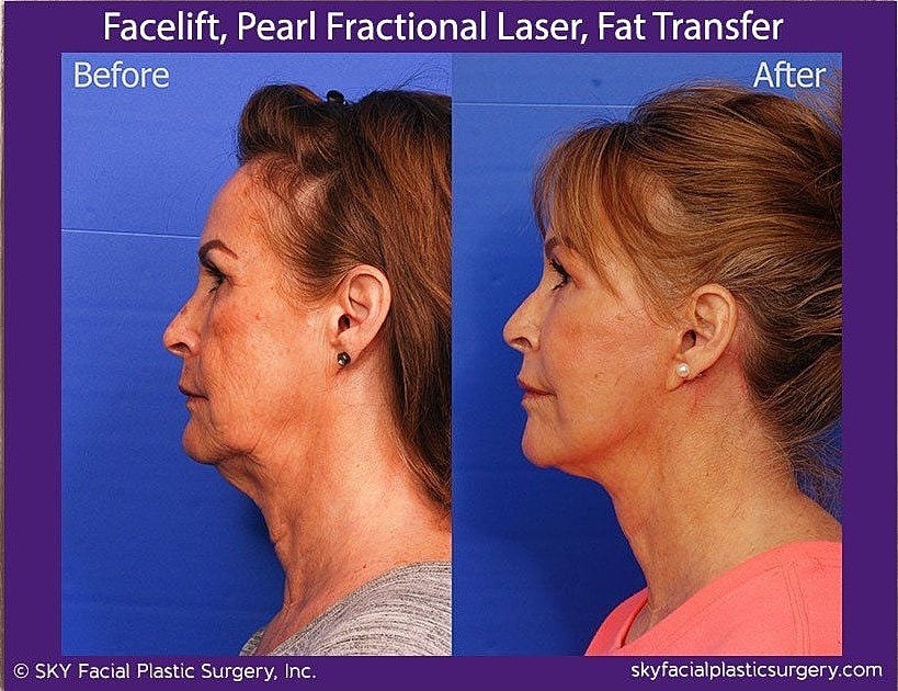 Facelift Before & After