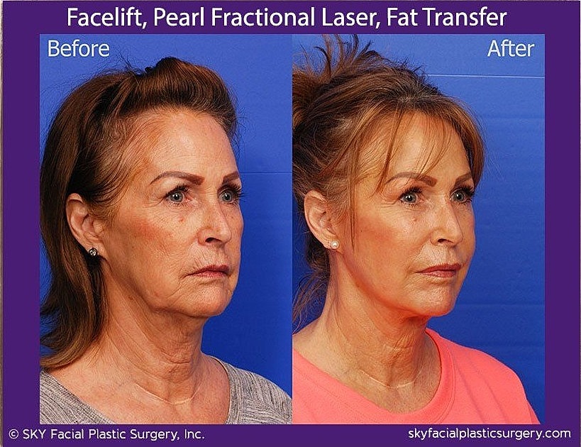 Facelift Before & After