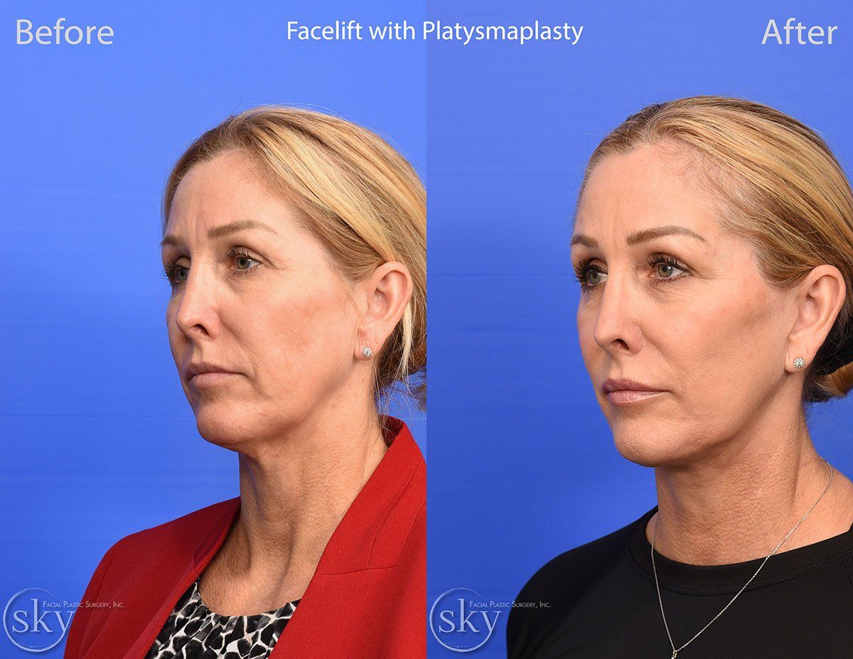 Facelift Before & After