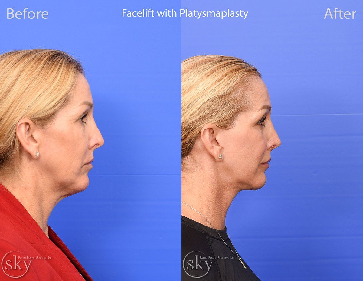 Facelift Before & After