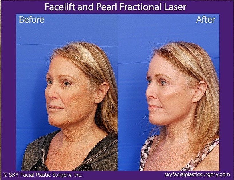 Facelift Before & After