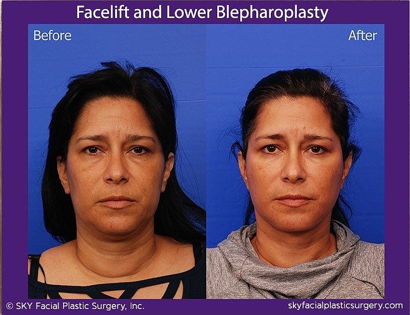 Facelift Before & After