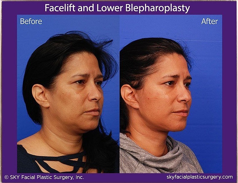 Facelift Before & After