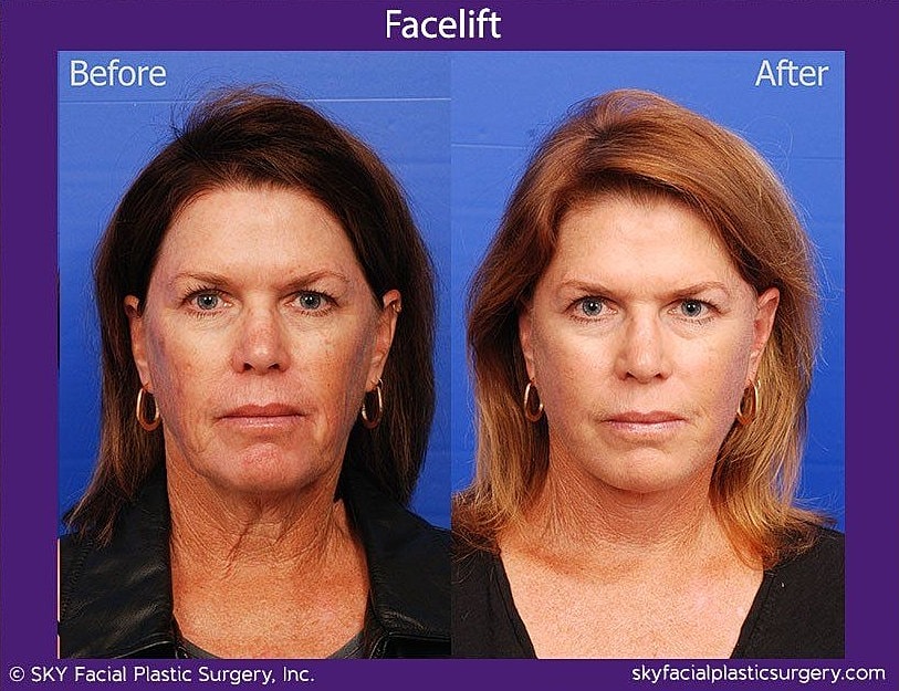 Facelift Before & After