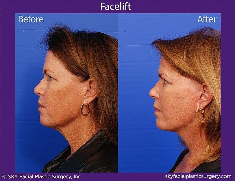 Facelift Before & After