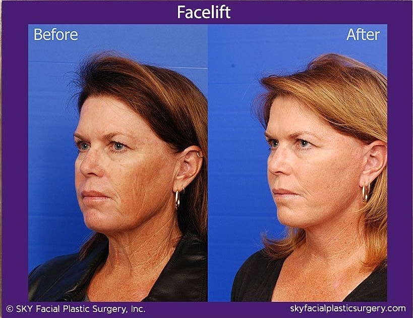 Facelift Before & After
