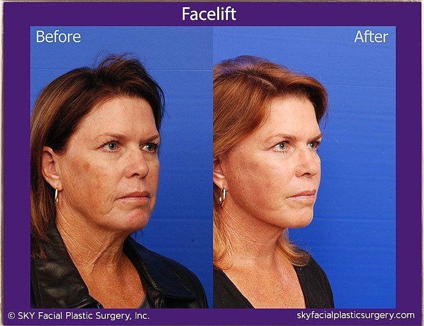 Facelift Before & After