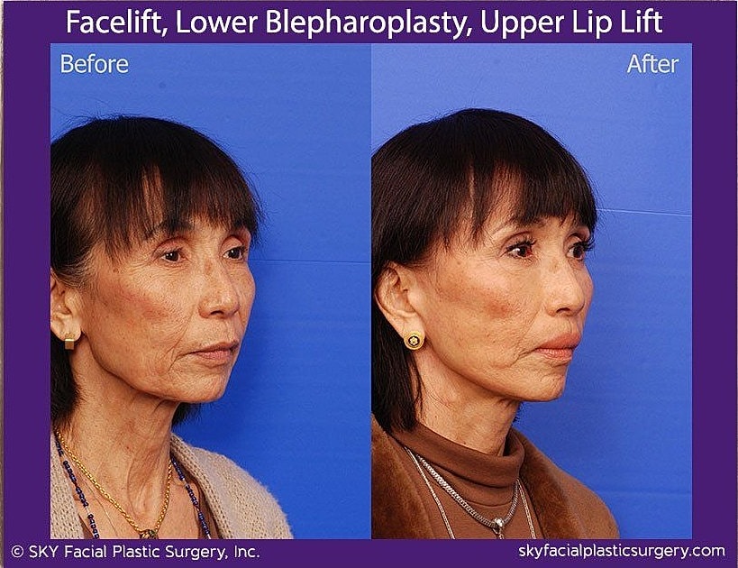 Facelift Before & After