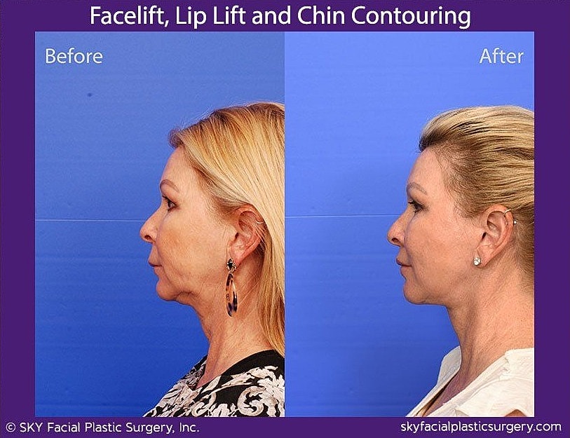 Facelift Before & After
