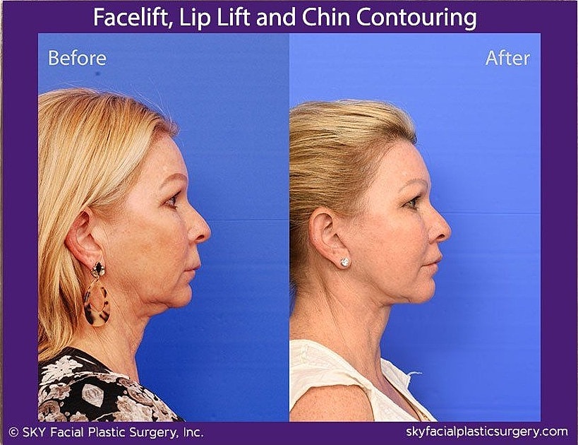 Facelift Before & After