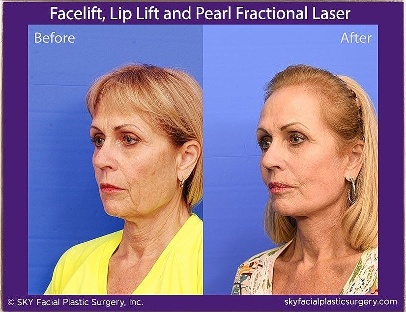 Facelift Before & After