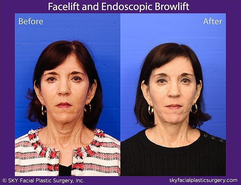 Facelift Before & After