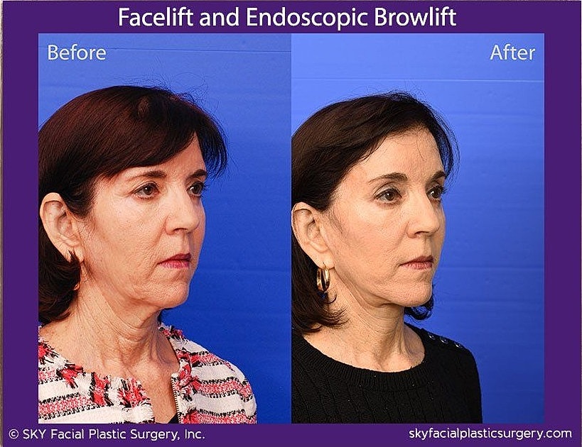 Facelift Before & After