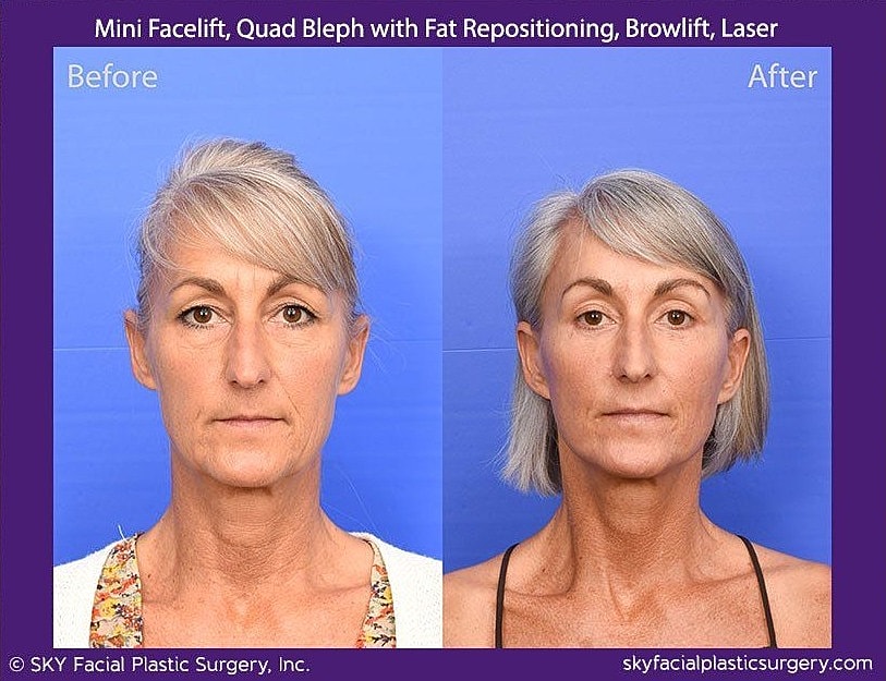 Facelift Before & After