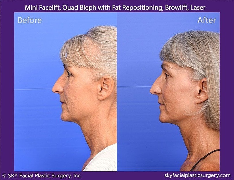 Facelift Before & After