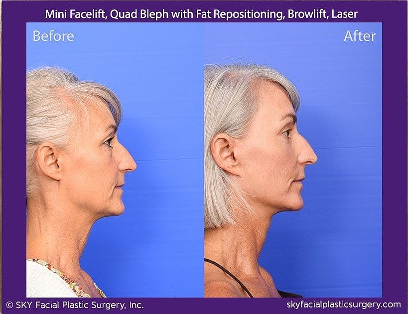 Facelift Before & After