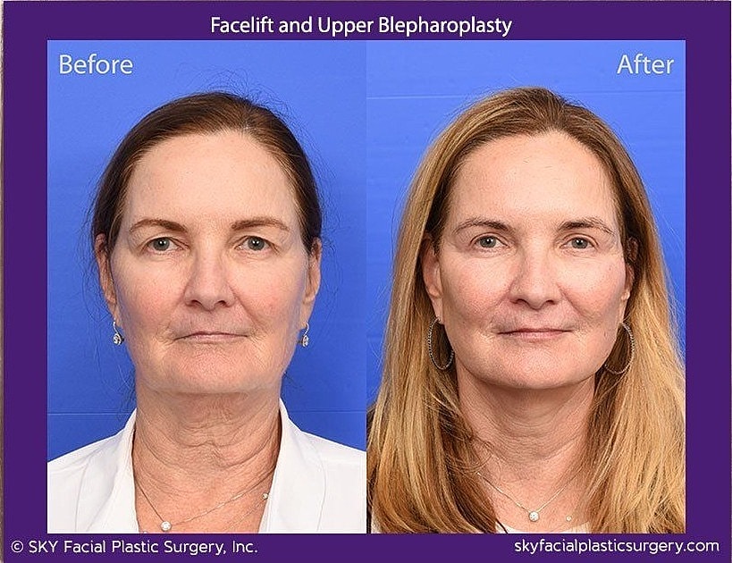 Facelift Before & After