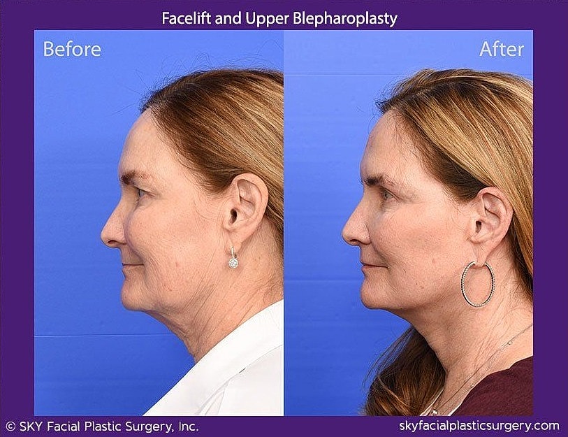 Facelift Before & After