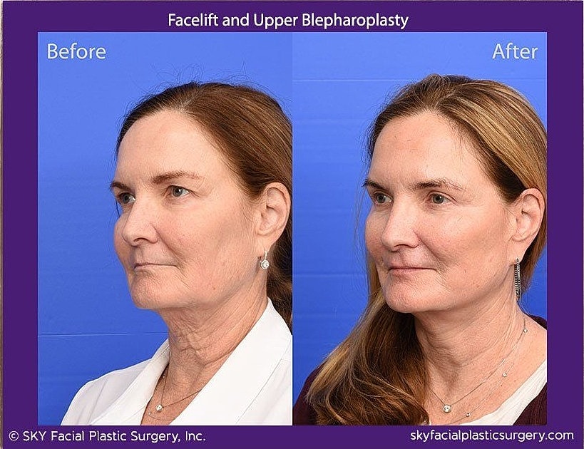 Facelift Before & After
