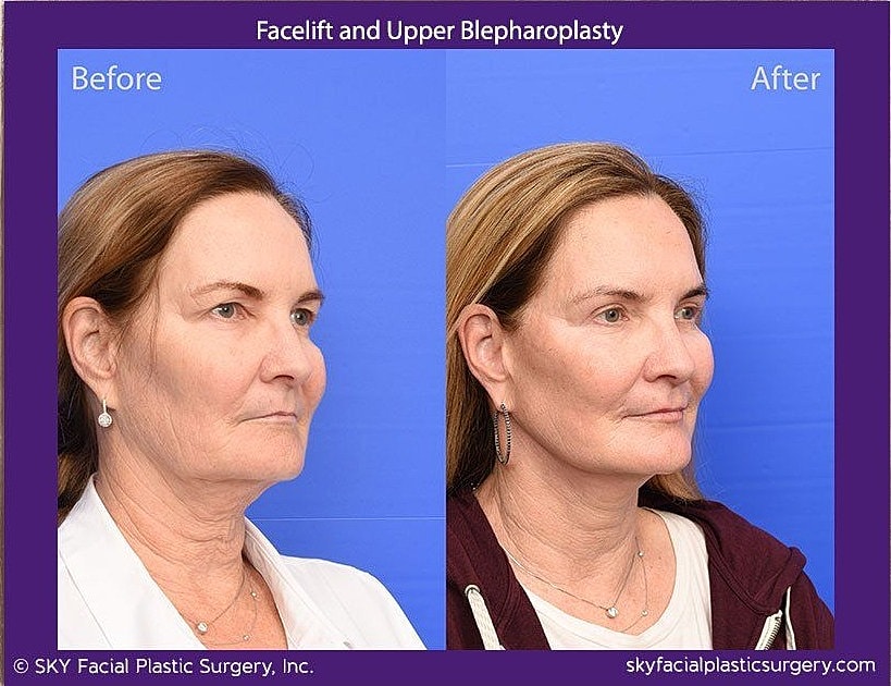 Facelift Before & After