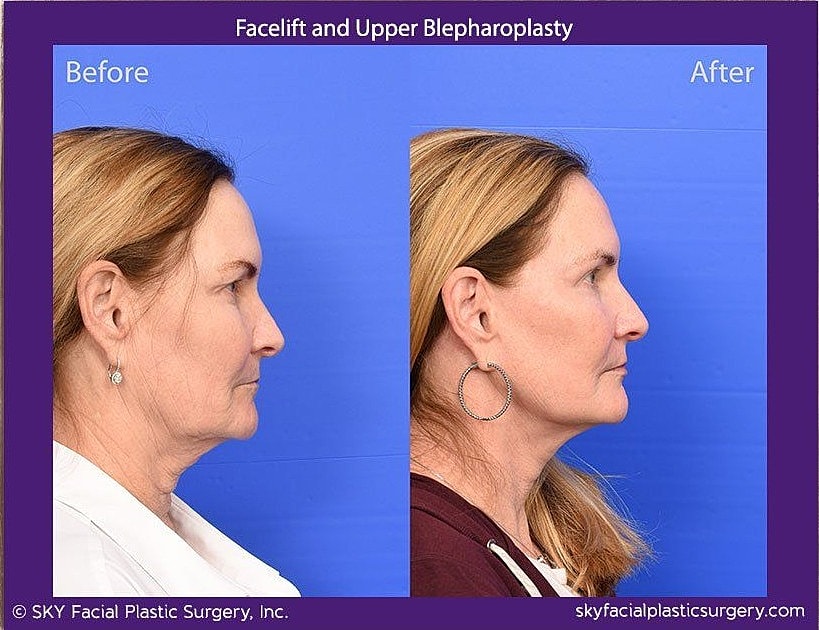 Facelift Before & After