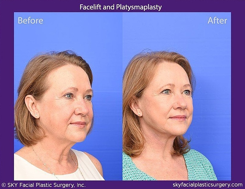 Facelift Before & After
