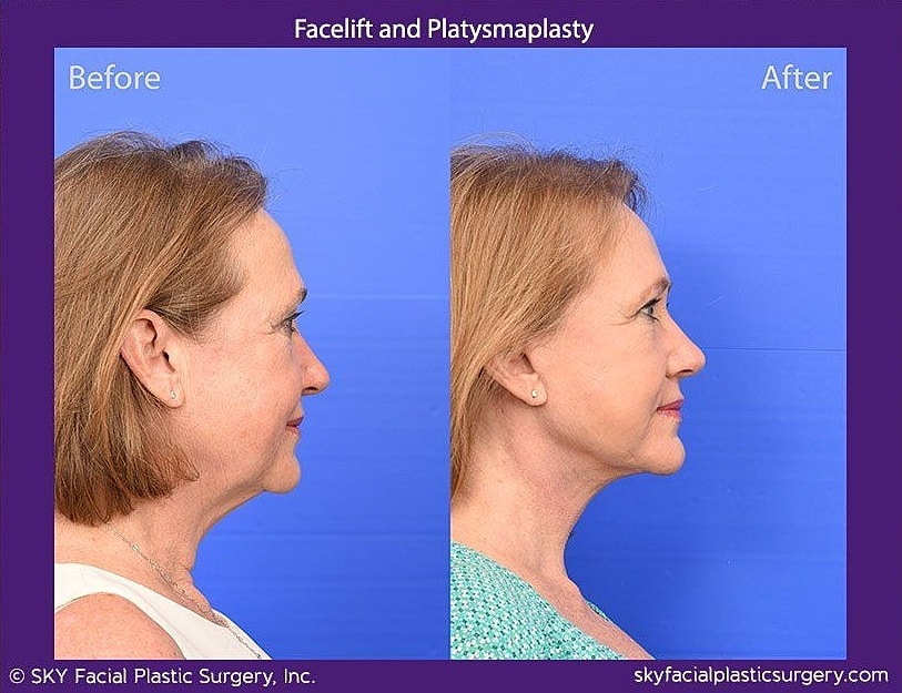 Facelift Before & After