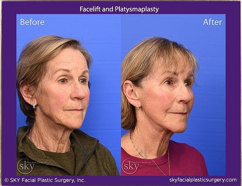 Facelift Before & After