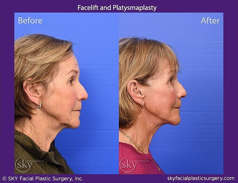 Facelift Before & After