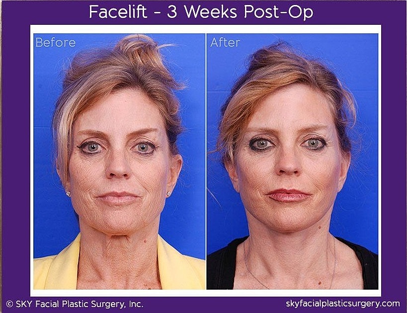 Facelift Before & After