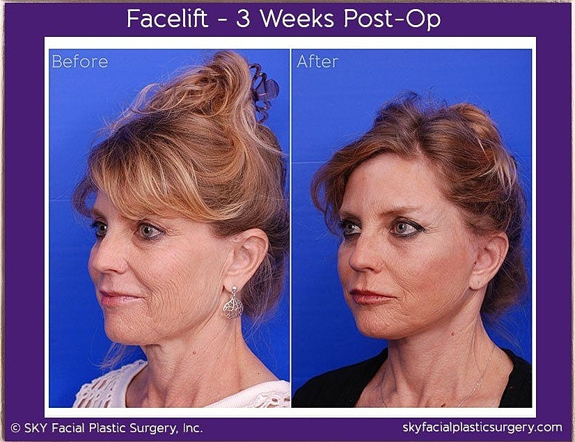 Facelift Before & After