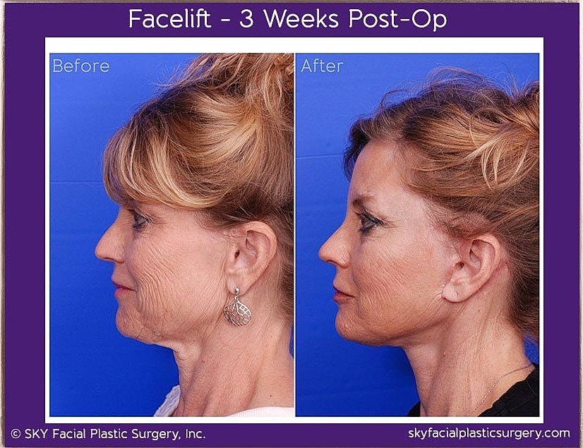 Facelift Before & After