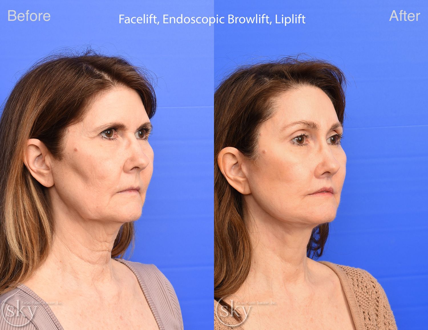 Lip Lift Before & After