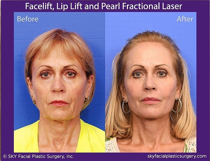 Lip Lift Before & After