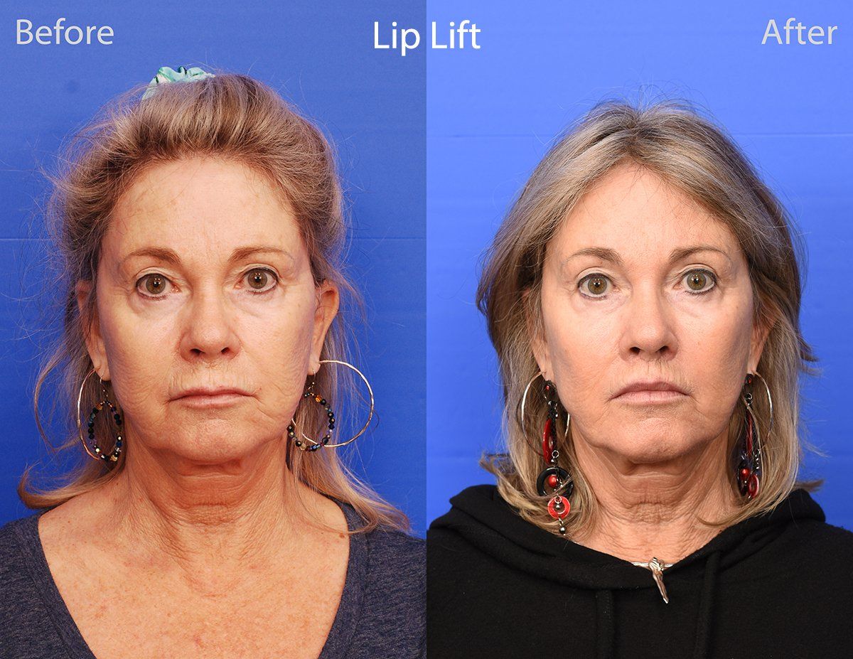 Lip Lift Before & After