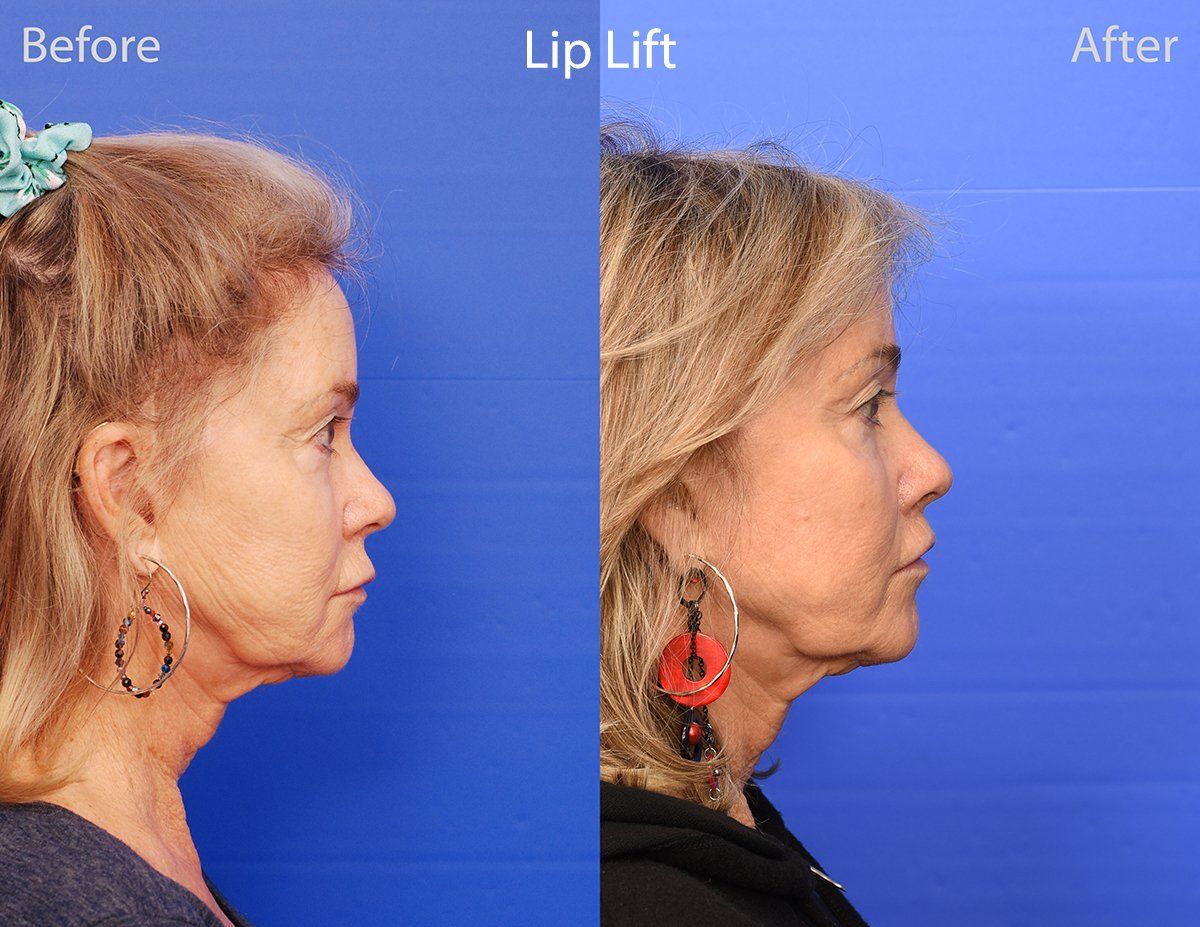 Lip Lift Before & After